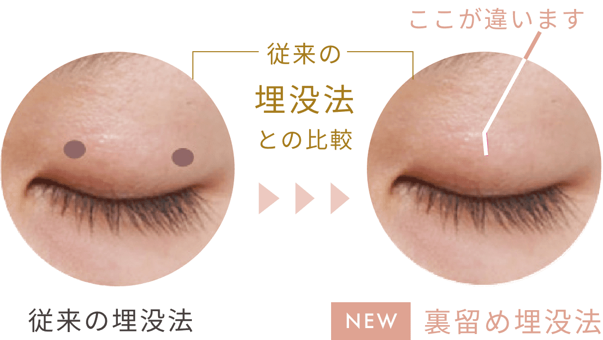 従来の埋没法との比較 従来の埋没法 裏留め埋没法 ここが違います