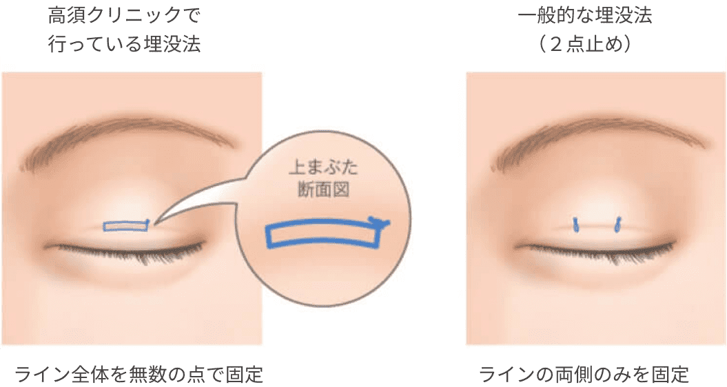 高須クリニックで行っている埋没法 ライン全体を無数の点で固定 一般的な埋没法（２点止め）ラインの両側のみを固定