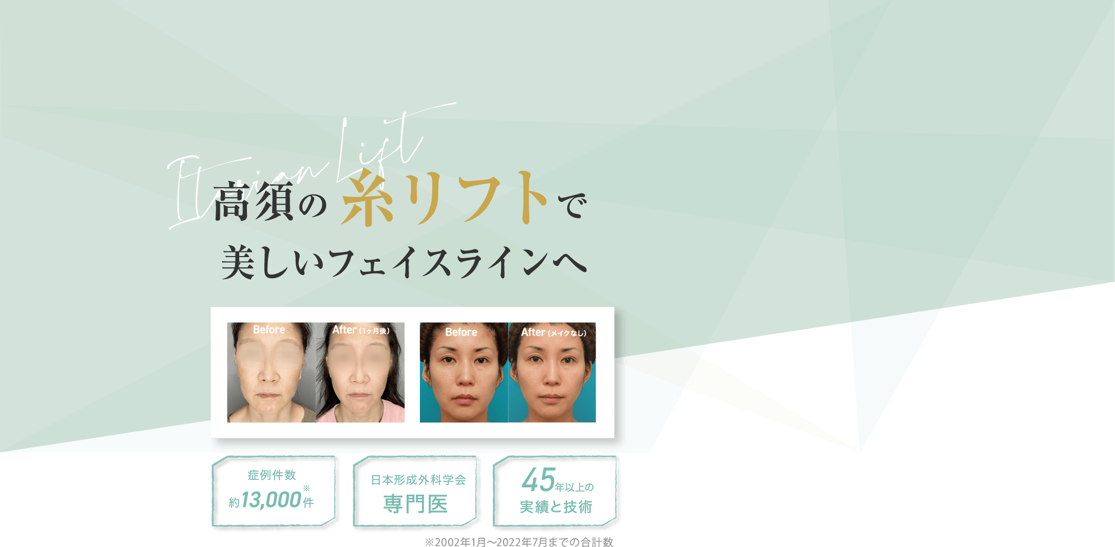 高須の糸リフトで美しいフェイスラインへ