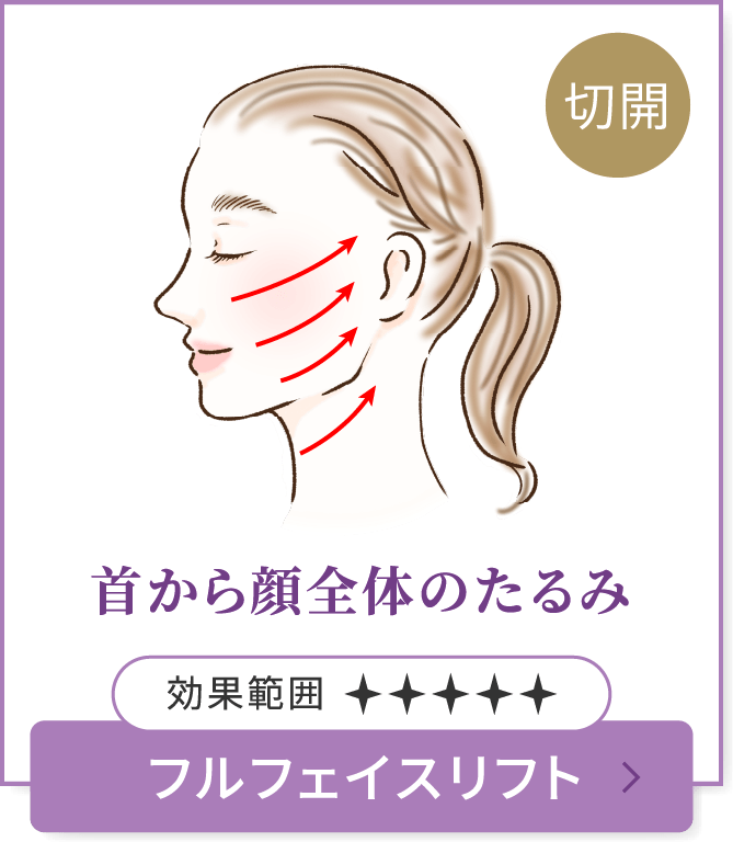 首から顔全体のたるみ　フルフェイスリフト