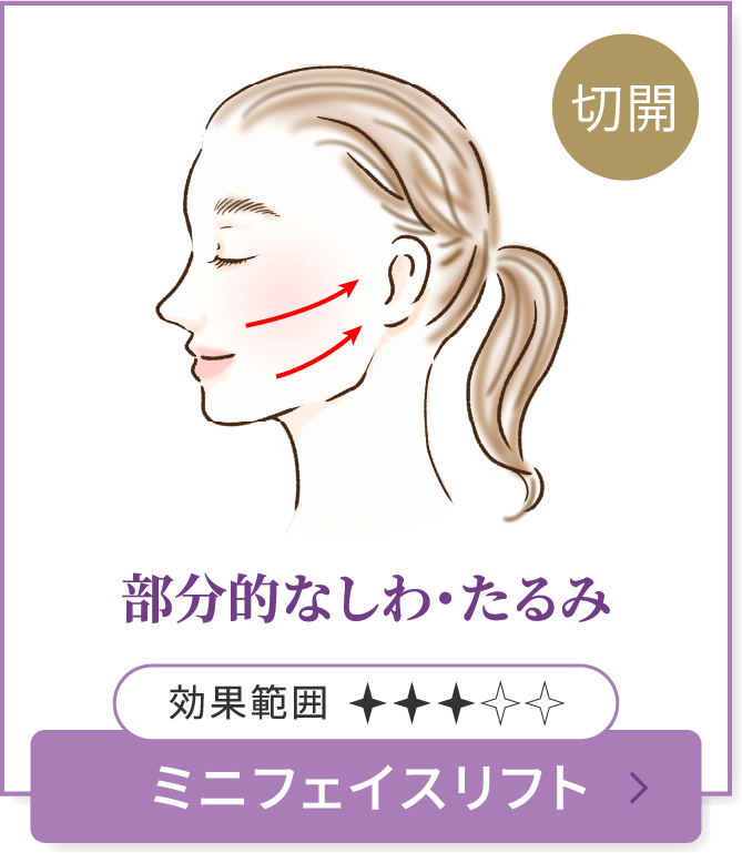 部分的なしわ・たるみ　ミニフェイスリフト