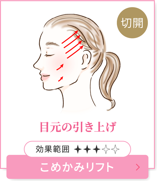 目元の引き上げ　こめかみリフト