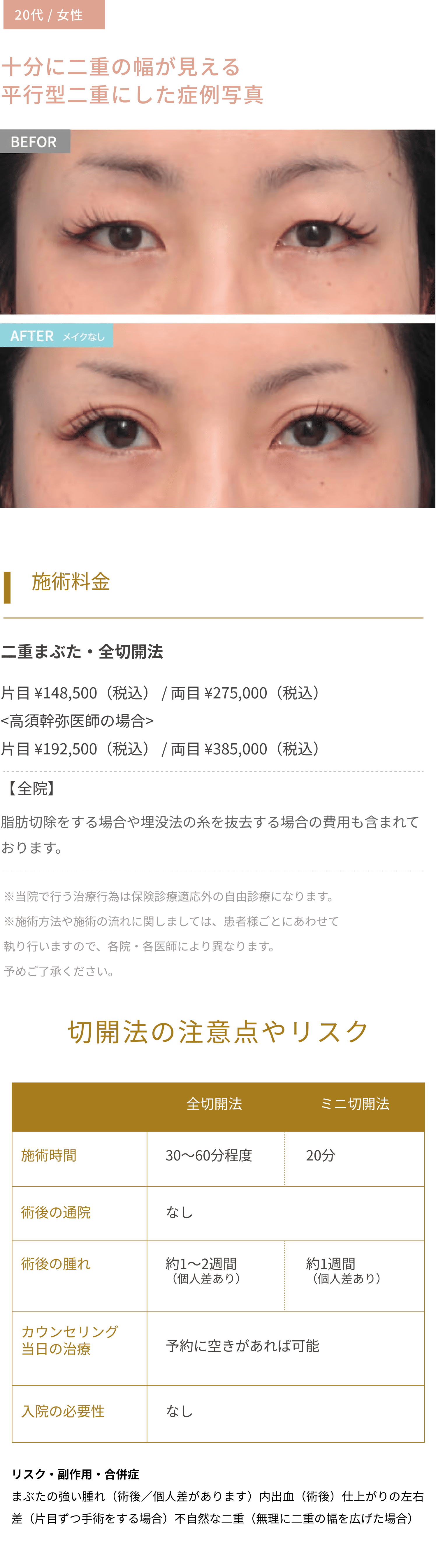 十分に二重の幅が見える平行型二重にした症例写真