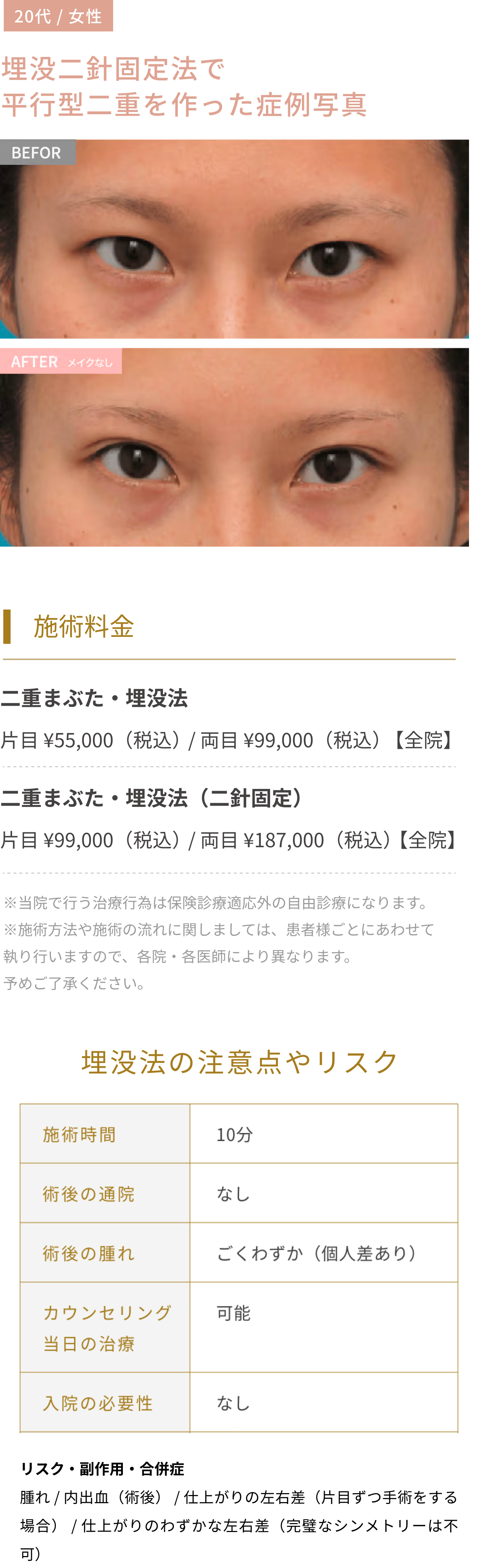 埋没二針固定法で
                平行型二重を作った症例写真