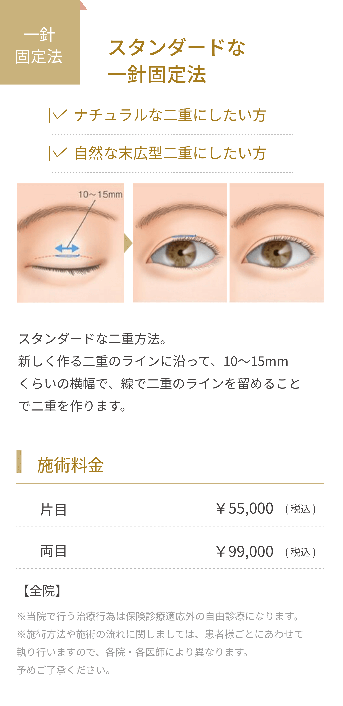 スタンダードな一針固定法