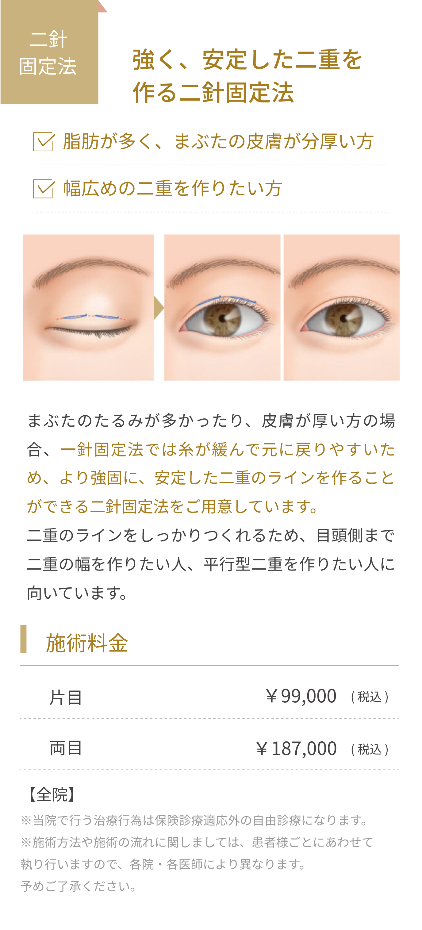 強く、安定した二重を作る二針固定法