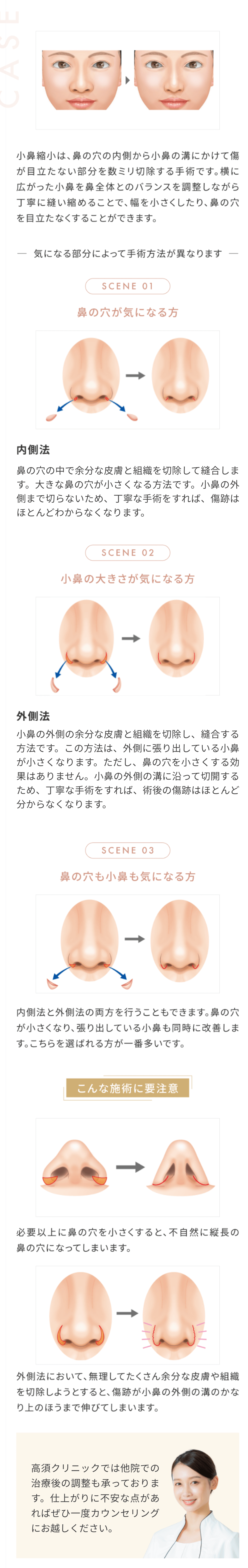 自然ですっきりした小鼻に