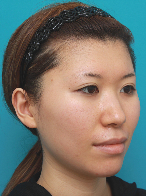 20代女性に行った金の糸（ゴールデンリフト）+法令ヒアルロン酸注射の症例写真症例写真 ： 美容皮膚科： 美容整形の