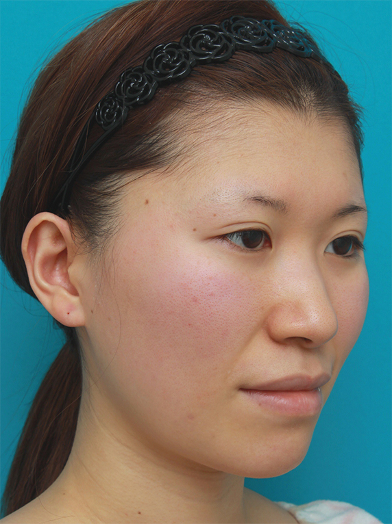 20代女性に行った金の糸（ゴールデンリフト）+法令ヒアルロン酸注射の症例写真症例写真 ： 美容皮膚科： 美容整形の高須クリニック