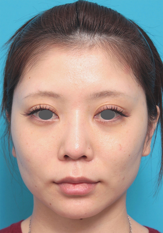 20代女性にウルセラシステムを行い、頬のたるみが引き締まり小顔になった症例写真症例写真 ： 美容皮膚科： 美容整形