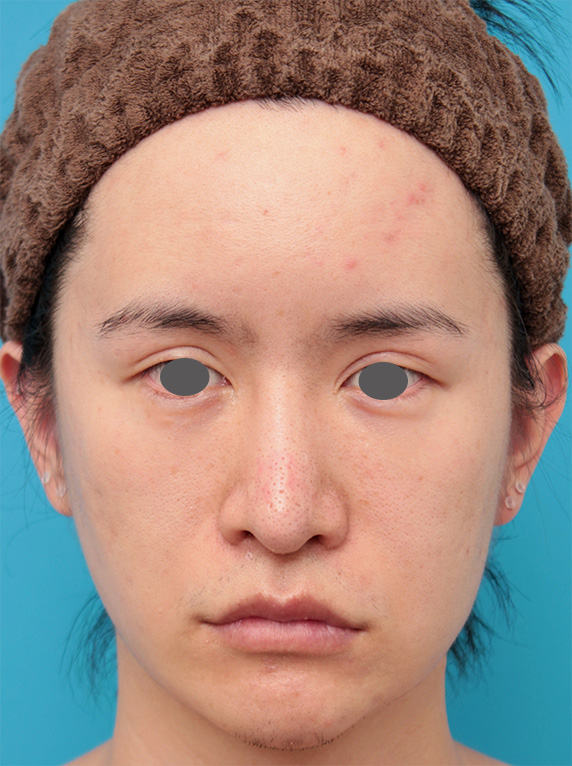 20代男性にウルセラシステムを行い、顔のたるみを引き締めた症例写真の術前術後画像症例写真 ： 美容皮膚科： 美容整形の高須クリニック