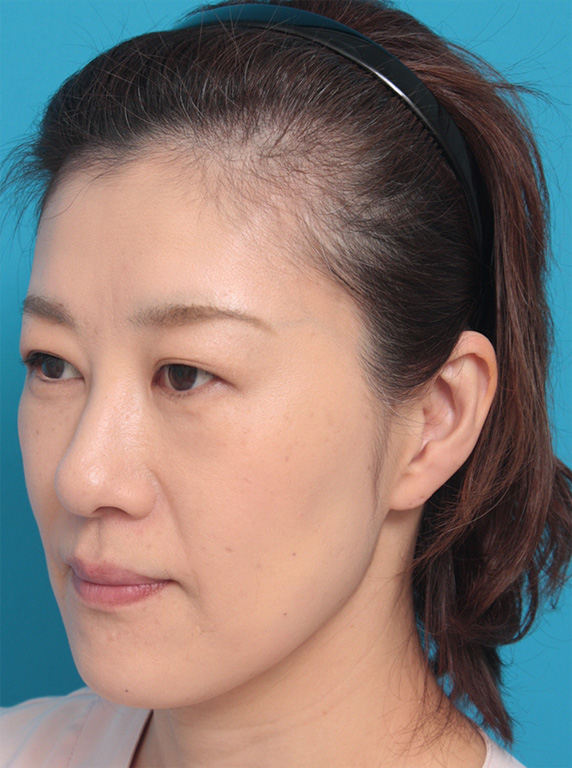 40代女性の顔と首にサーマクールを照射した症例写真症例写真 ： 美容皮膚科： 美容整形の高須クリニック