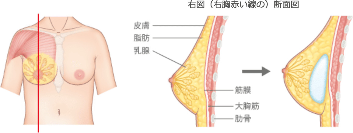 右図（右胸赤い線の）断面図