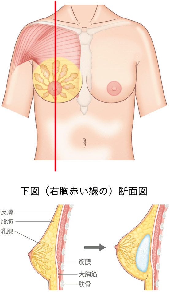 下図（右胸赤い線の）断面図