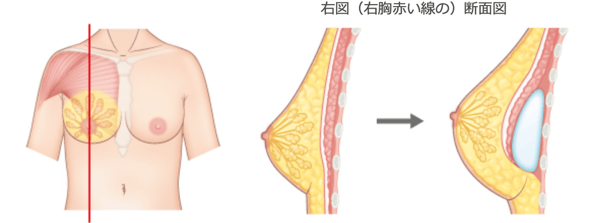 右図（右胸赤い線の）断面図