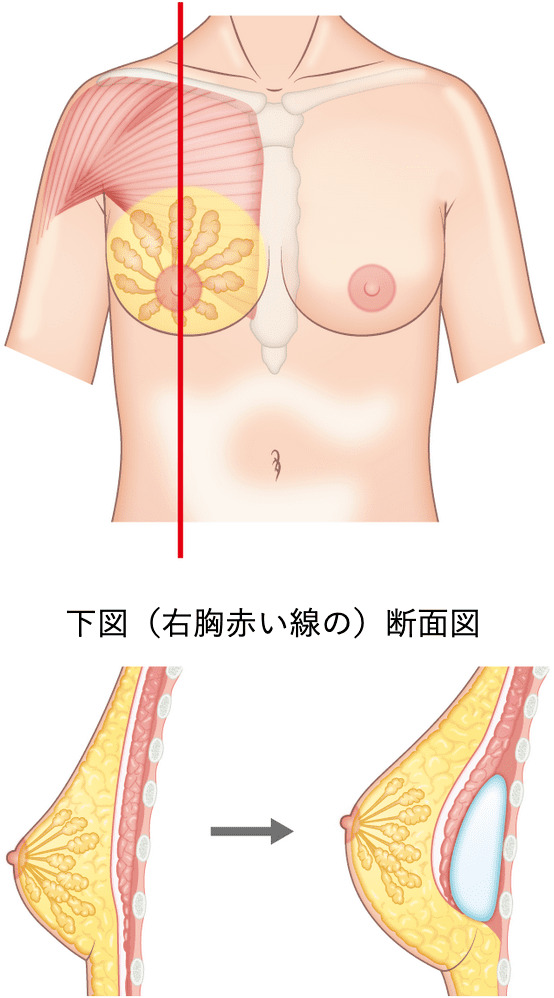 下図（右胸赤い線の）断面図