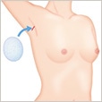 豊胸手術(シリコンプロテーゼ)