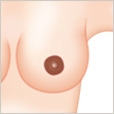 乳頭・乳輪黒ずみ除去