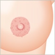 乳輪のぶつぶつ(モントゴメリー腺)除去