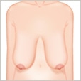 下垂乳房形成(垂れ乳修正)