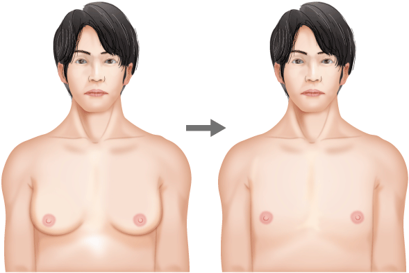 女性化乳房の手術は具体的にどういうことをするのか Dr 高須幹弥の美容整形講座 美容整形の高須クリニック
