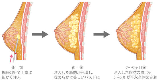 セリューション脂肪注入豊胸 ： 豊胸・バスト・乳首：美容外科 高須