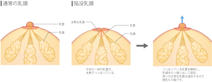 【通常の乳頭】　【陥没乳頭】中央の一部の乳管が、未熟でつっぱっている→つっぱっている乳管を解除し、乳頭をひっぱり出して固定。周りの正常な乳管は温存するので、授乳も可能です。