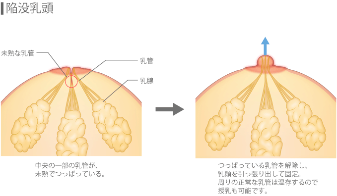 【陥没乳頭】中央の一部の乳管が、未熟でつっぱっている→つっぱっている乳管を解除し、乳頭をひっぱり出して固定。周りの正常な乳管は温存するので、授乳も可能です。