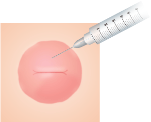 　乳首　陥没 陥没乳頭 ： 豊胸・バスト・乳首：美容外科 高須クリニック