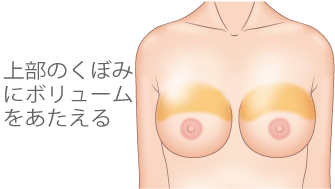 上部のくぼみにボリュームをあたえる!