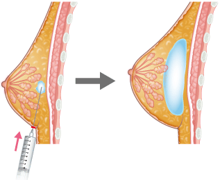 バストへのヒアルロン酸注入豊胸術のメカニズム