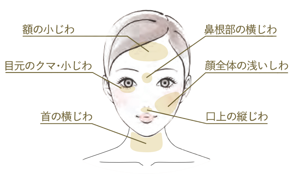 額の小じわ　鼻根部の横じわ　目元のクマ・小じわ　顔全体の浅いしわ　口上の縦じわ　首の横じわ