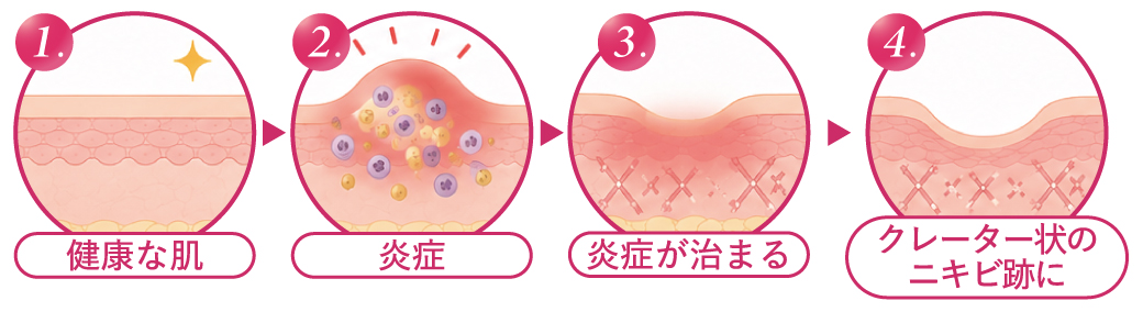 1.健康な肌／2.炎症／3.炎症が治まる／4.クレーター状のニキビ跡に