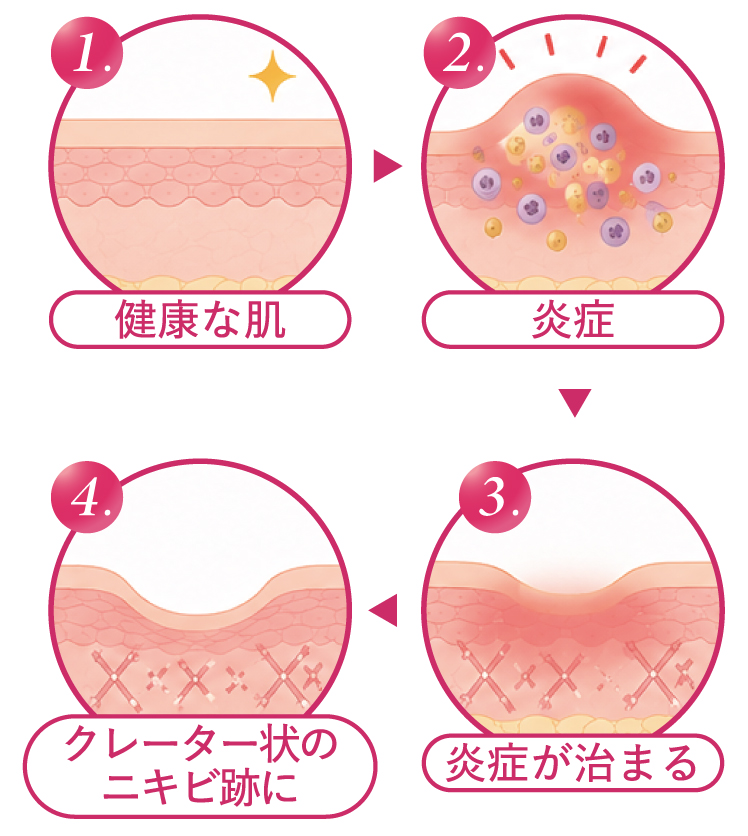 1.健康な肌／2.炎症／3.炎症が治まる／4.クレーター状のニキビ跡に