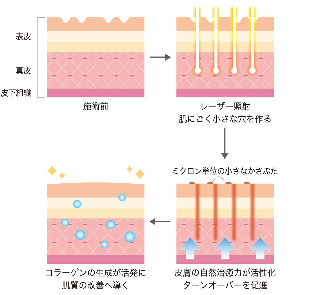 施術前 表皮・真皮・皮下組織→レーザー照射 肌にごく小さな穴を作る→皮膚の自然治癒力が活性化 ターンオーバーを促進 ミクロン単位の小さなかさぶた→コラーゲンの生成が活発に 肌質の改善へ導く