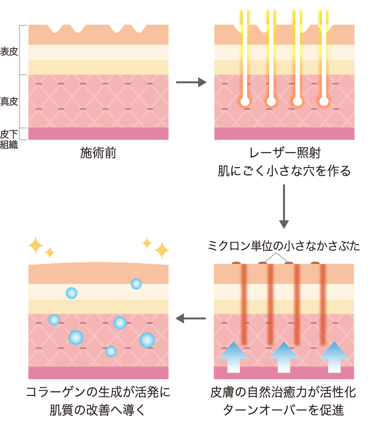 施術前 表皮・真皮・皮下組織→レーザー照射 肌にごく小さな穴を作る→皮膚の自然治癒力が活性化 ターンオーバーを促進 ミクロン単位の小さなかさぶた→コラーゲンの生成が活発に 肌質の改善へ導く