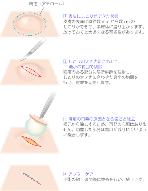 1.表皮にしこりができた状態 2.しこりの大きさに合わせて、最小の範囲で切除 3.腫瘍の再発の原因となる袋ごと除去 4.アフターケア