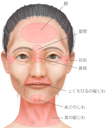 額　眉間　目尻　鼻根　上くちびるの縦皺　あごのしわ