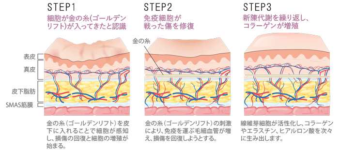 STEP1.細胞が金の糸（ゴールデンリフト）が入ってきたと認識「金の糸（ゴールデンリフト）を皮下に入れることで、細胞が感知します。」STEP2.免疫細胞が戦った傷を修復「金の糸（ゴールデンリフト）の刺激により、免疫を運ぶ毛細血管が大量に伸びはじめ、損傷を回復しようとします。」STEP3.新陳代謝を繰り返し、コラーゲンが増殖「「繊維芽細胞」が活性化し、コラーゲン・エラスチン、ヒアルロン酸を次々に生み出します。」