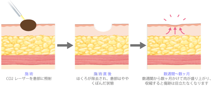 【施術】CO<sub>2</sub>レーザーを患部に照射　【施術直後】ほくろが除去され、患部はややくぼんだ状態　【数週間～数ヶ月】数週間から数ヶ月かけて肉が盛り上がり、収縮すると傷跡は目立たなくなります