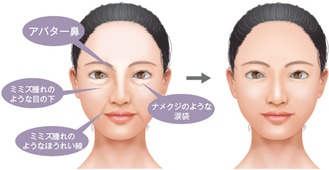 「ヒアルロン酸」の画像検索結果