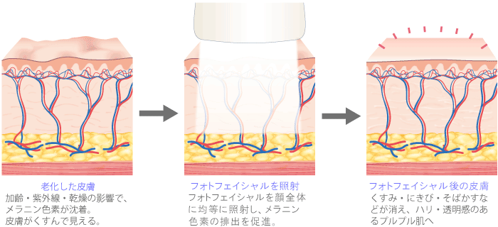 【老化した皮膚】加齢・紫外線・乾燥の影響で、メラニン色素が沈着。皮膚がくすんで見えます。　【IPLを照射】IPLを顔全体に均等に照射し、メラニン色素の排出を促進。　【IPL後の皮膚】くすみ・にきび・そばかすなどが消え、ハリ・透明感のあるプルプル肌へ。