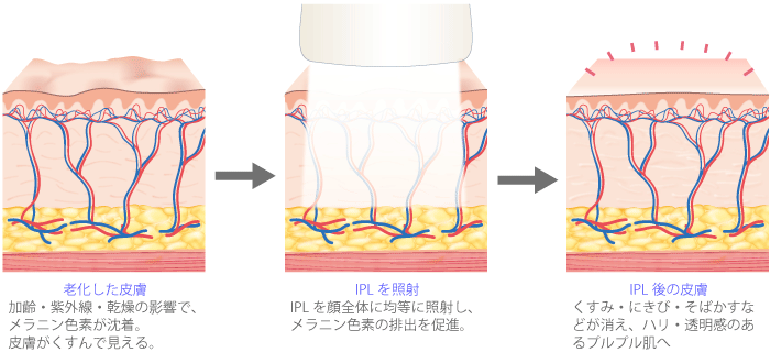 【老化した皮膚】加齢・紫外線・乾燥の影響で、メラニン色素が沈着。皮膚がくすんで見えます。　【IPLを照射】IPLを顔全体に均等に照射し、メラニン色素の排出を促進。　【IPL後の皮膚】くすみ・にきび・そばかすなどが消え、ハリ・透明感のあるプルプル肌へ。