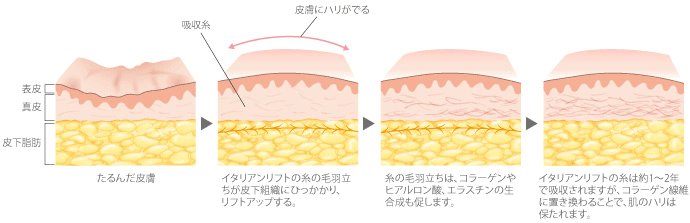 たるんだ皮膚→糸の毛羽立ちが皮下組織にひっかかり、リフトアップ→糸の毛羽立ちはコラーゲン・ヒアルロン酸・エラスチンの生合成も促します→糸は約8～10ヶ月で完全に吸収されますが、コラーゲン繊維に置き換わり、肌のハリは保たれます