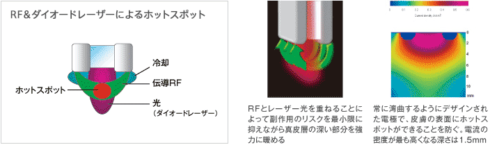 ポラリスWRによるホットスポット RFとレーザー光を重ねることによって副作用のリスクを最小限に抑えながら真皮層の深い部分を強力に暖める 常に歪曲するようにデザインされた電極で、皮膚の表面にホットスポットができることを防ぐ。電流の密度が最も高くなる深さは1.5mm