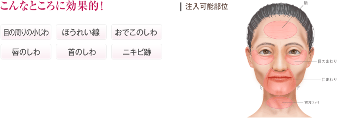 こんなところに効果的！　目の周りのこじわ、ほうれい線、おでこのしわ、唇のしわ、首のしわ、ニキビ跡　【注入可能部位】額　目の周り　首まわり　口のまわり