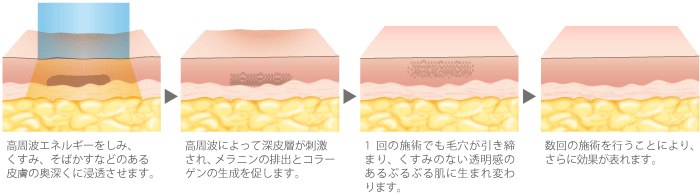 高周波エネルギーをしみ、くすみ、そばかすなどのある皮膚の奥深くに浸透させます。→高周波によって深皮層が刺激され、メラニンの排出とコラーゲンの生成を促します。→1回の施術でも毛穴が引き締まり、くすみのない透明感のあるぷるぷる肌に生まれ変わります。数回の施術を行うことによりさらに効果が表れます。
