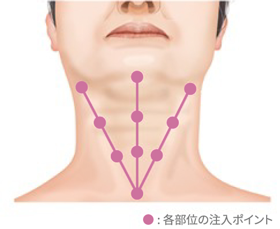 各部位の注入ポイント