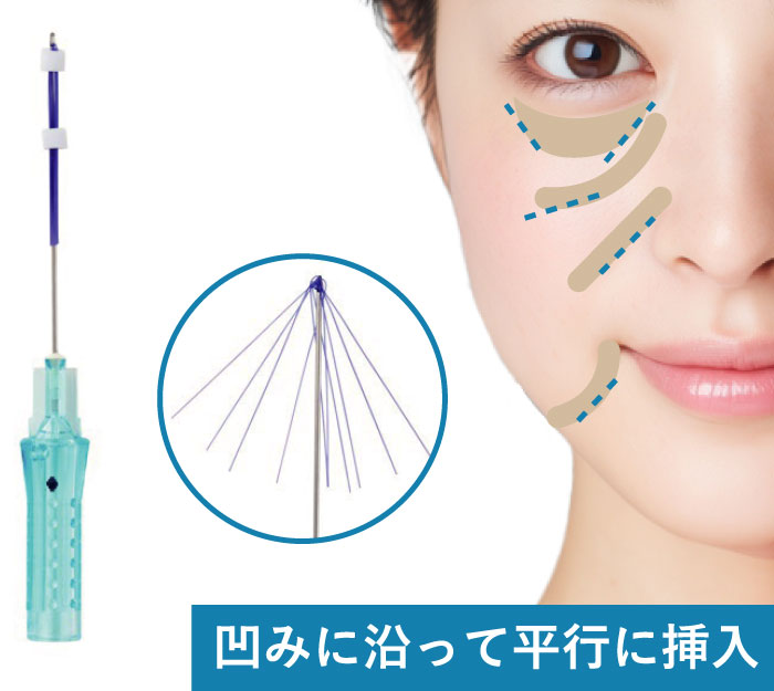 凹みに沿って平行に挿入