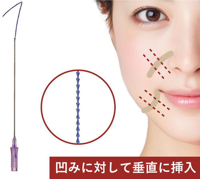 凹みに対して垂直に挿入